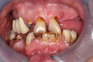 Befoer implant supported dentures
