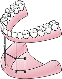 Clip and bar implant denture