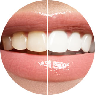 Teeth Whitening in Modesto, CA